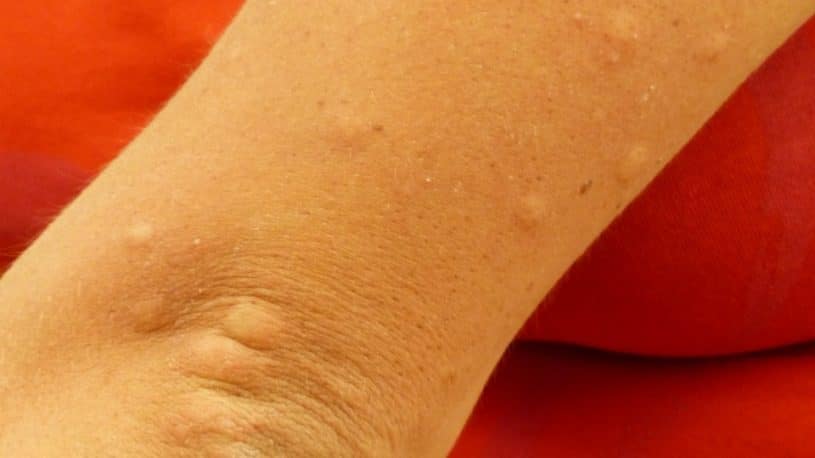mosquito bites on human's arm